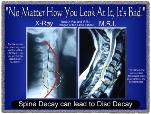 Herniated Disc, Oakleigh, VIC Chiropractor