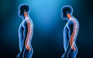 Chiropractic Care For Kyphosis St Paul MN